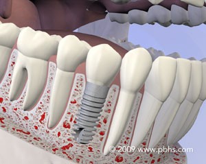 Implants diagram
