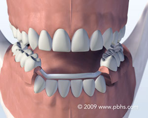 Metal partials NY
