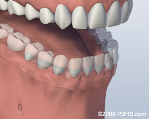 Missingallfour upper teeth