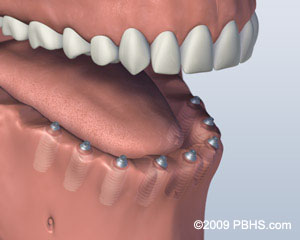 Missing All Upper or Lower Teeth
