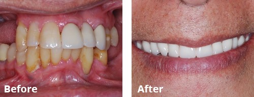 dental implant 4