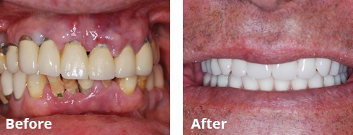 dental implant 1