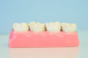 wisdom teeth removal